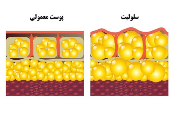 ۵ راه ساده برای درمان سلولیت در خانه