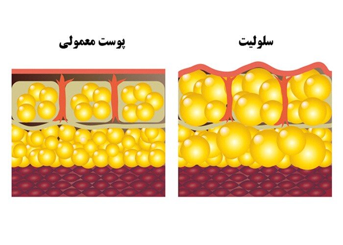 ۵ راه ساده برای درمان سلولیت در خانه